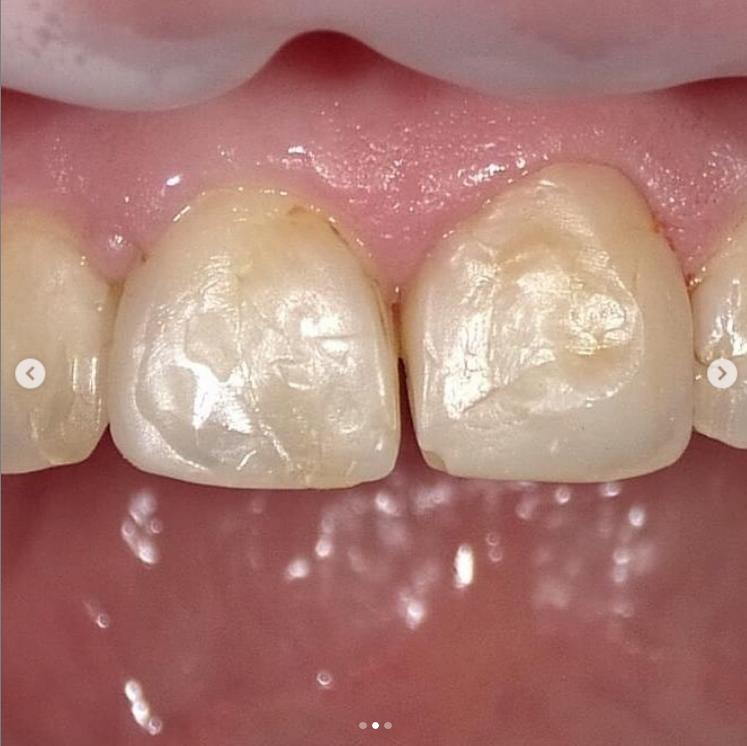 Лечение передних зубов в уфе