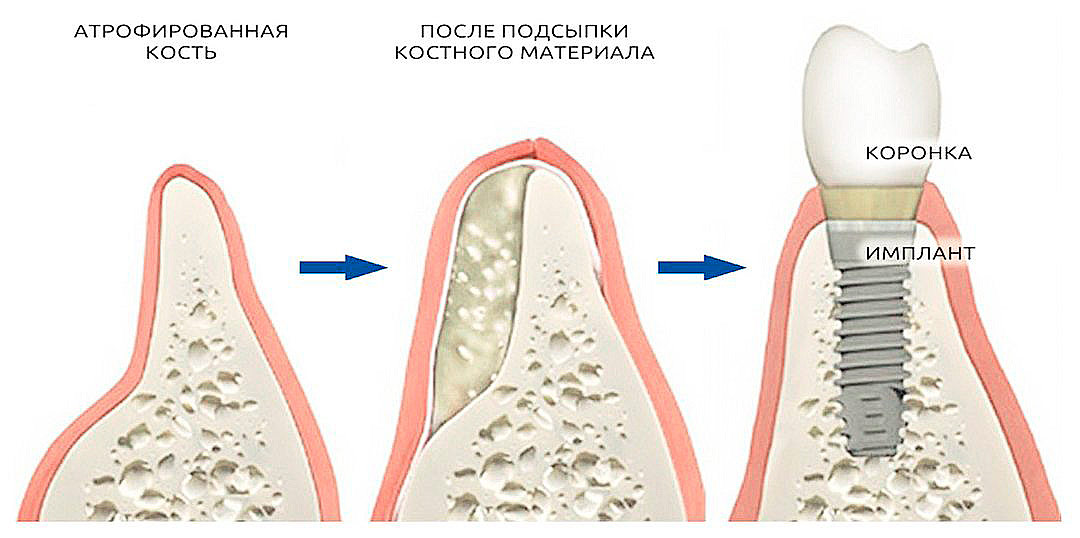 Наращивание объема костной ткани при атрофии с последующей установкой имплантата.