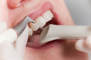 удаление зубного налета и чистка зубов Air flow