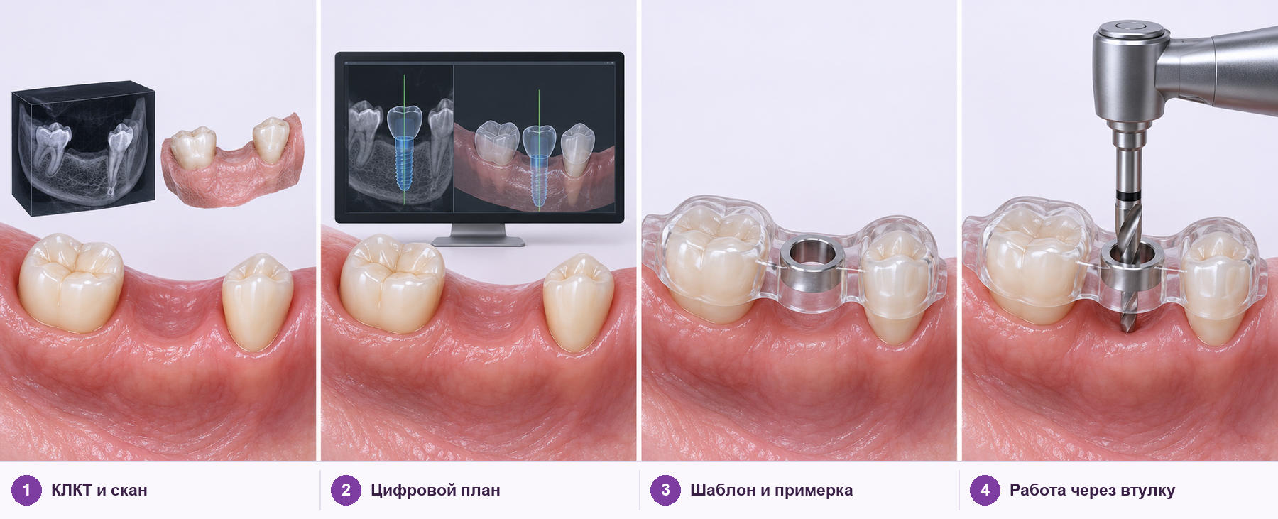 Четыре этапа имплантации по хирургическому шаблону: КЛКТ и скан, цифровое планирование, примерка шаблона, подготовка ложа через направляющую втулку
