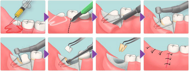 процедура удаления ретинированного зуба