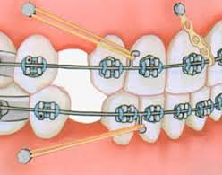 установка ортодонтических винтов