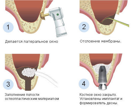 этапы наращивания костной ткани