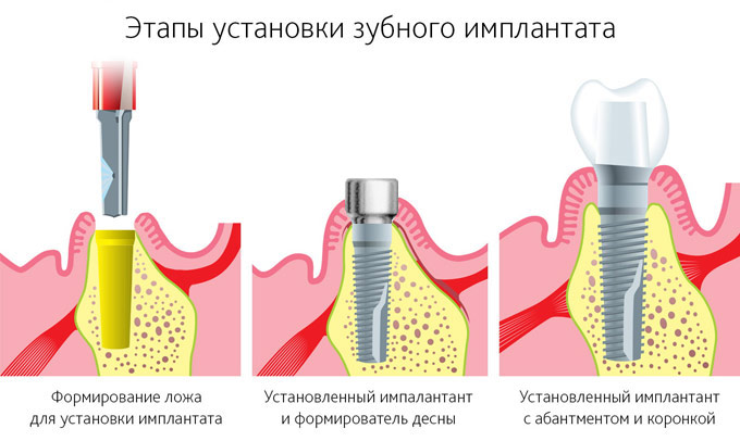 Основные этапы дентальной инплантации зубов в стоматологии Z32.