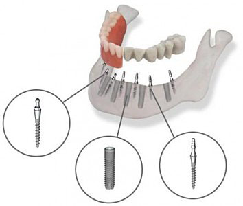 установка временных зубных имплантов в Уфе