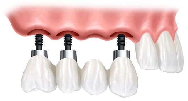 Лечение и протезирование зубов в рассрочку уфа thumbnail