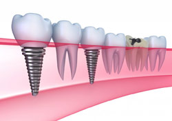 дентальная имплантация зубов в Уфе