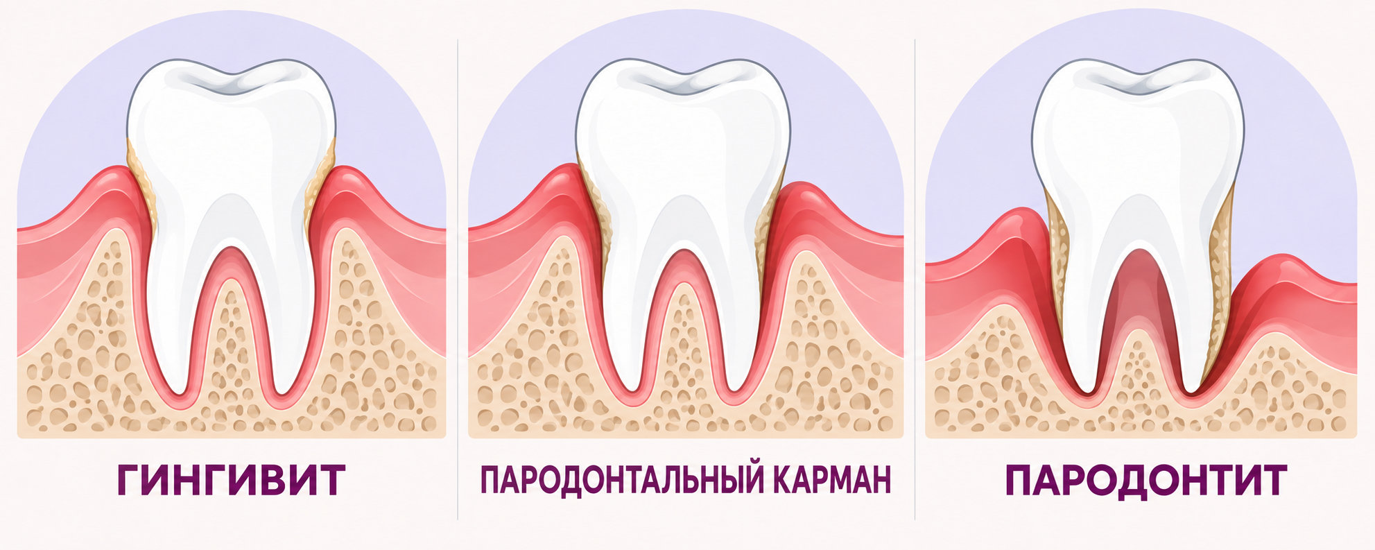 Гингивит и пародонтит: пародонтальный карман и состояние костной ткани