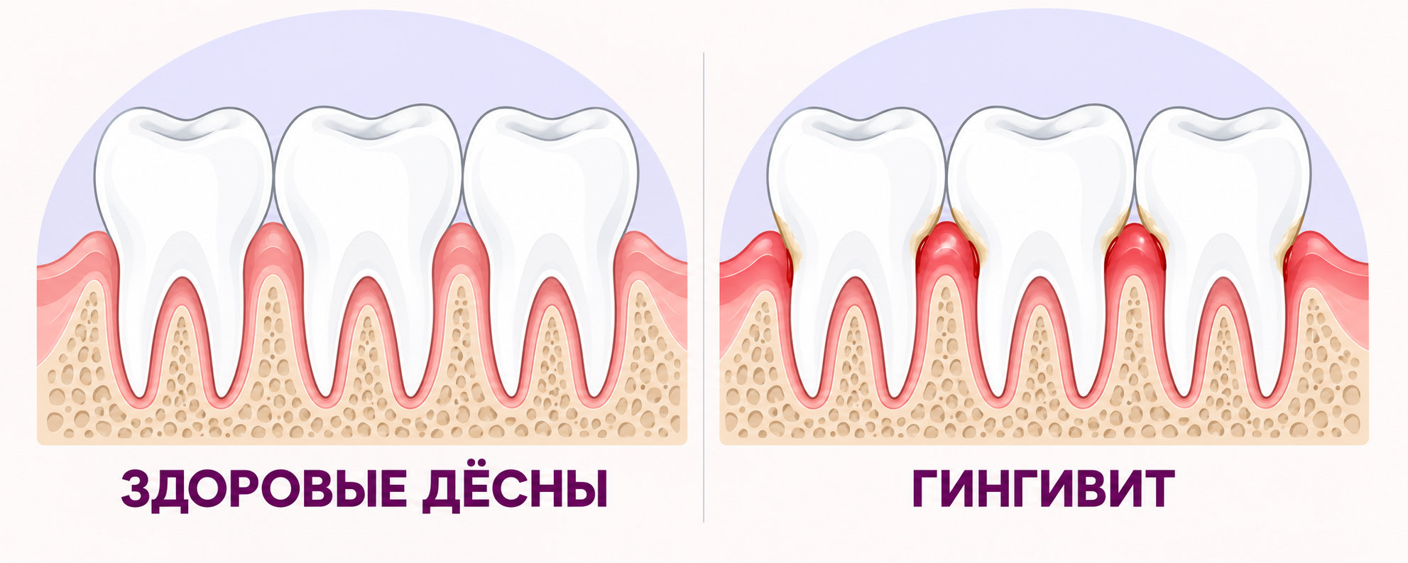 Лечение гингивита дёсен в Уфе: здоровая и воспалённая десна