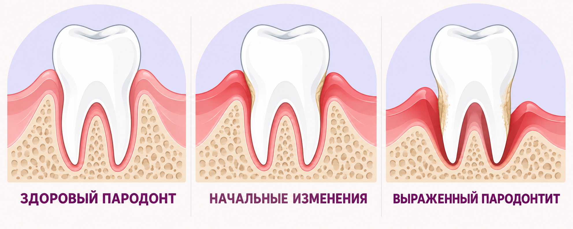 Лечение пародонтита в Уфе: изменения десны и костной опоры зуба