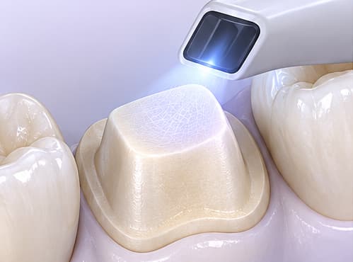 Внутриротовой сканер снимает форму подготовленного зуба и соседних зубов.
