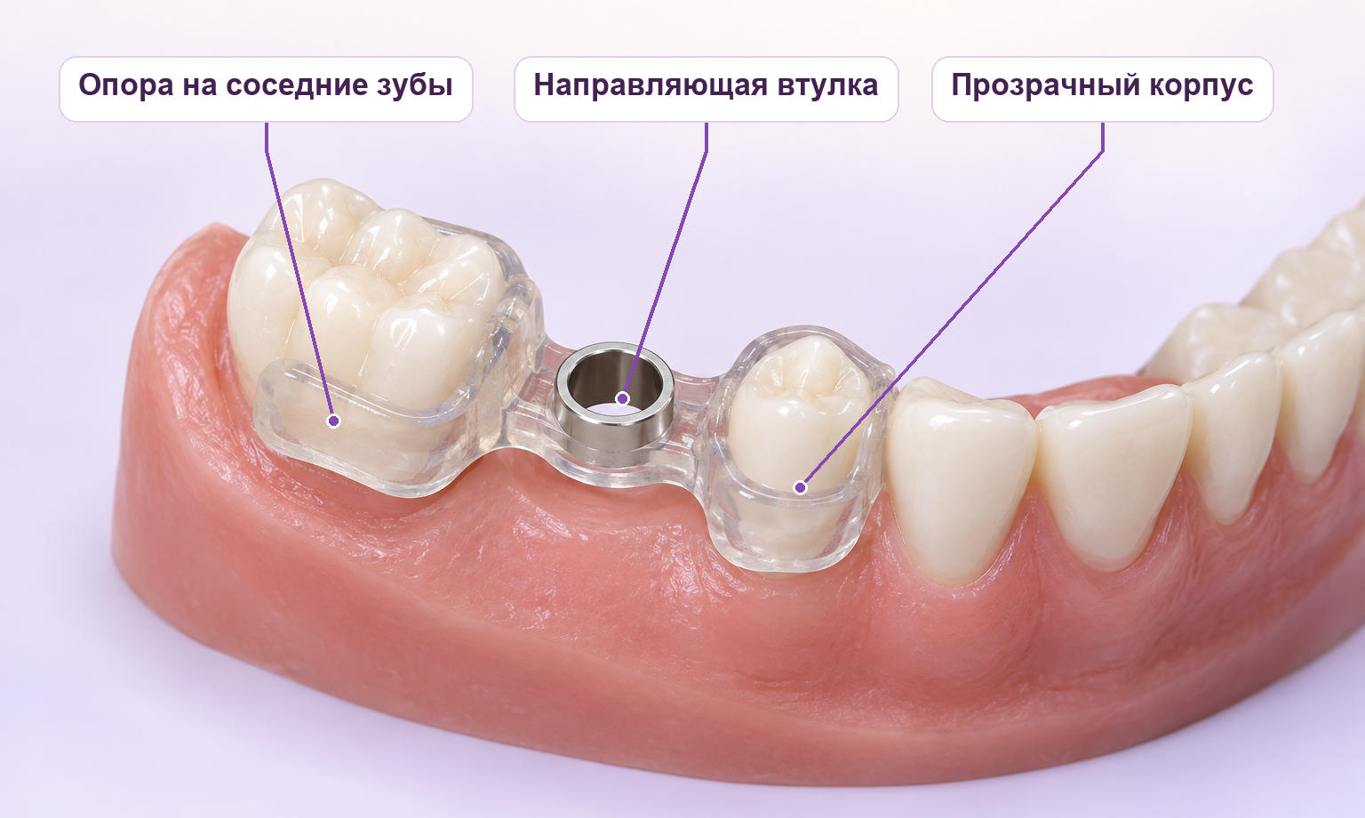 Хирургический шаблон для области отсутствующего нижнего правого второго премоляра: прозрачный корпус опирается на зубы 46 и 44, металлическая втулка открыта над местом установки имплантата