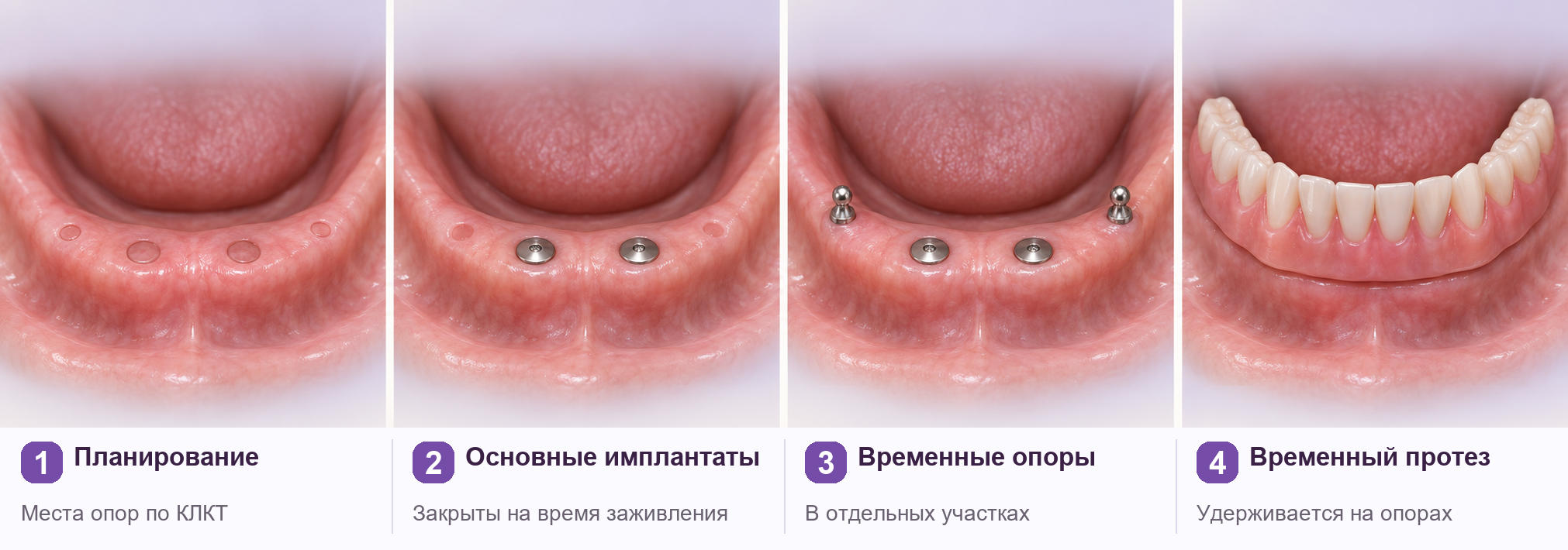 Четыре этапа: планирование по КЛКТ, установка основных имплантатов, установка отдельных временных опор и фиксация временного протеза