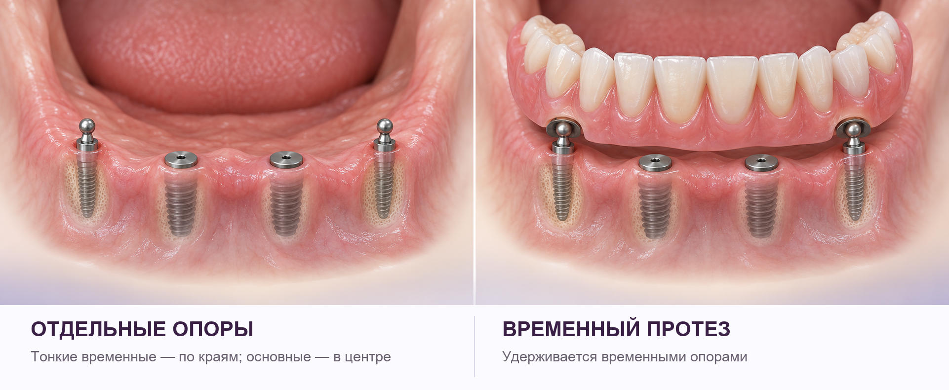 Схема нижней челюсти: тонкие временные имплантаты по краям удерживают промежуточный протез, основные имплантаты в центре закрыты