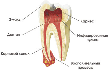 лечение корневых каналов зуба в Уфе