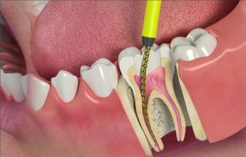 чистка и пломбирование каналов зуба в Уфе